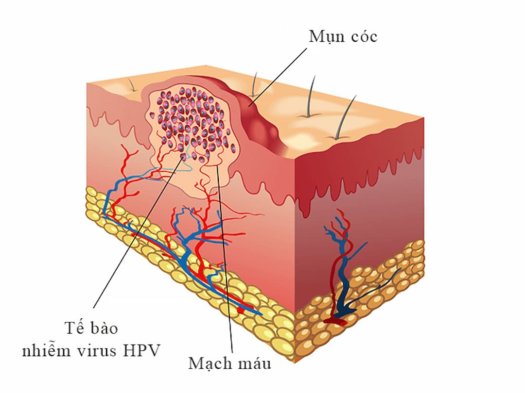 Mụn cóc kích thước tương đương với hạt cơm nên thường được gọi là mụn cơm