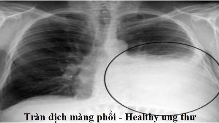 Nguyên nhân dẫn đến tràn dịch màng phổi ở con người