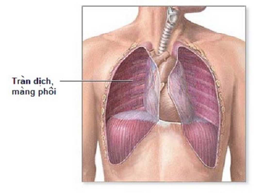 Triệu chứng cho thấy bị bệnh ở màng phổi