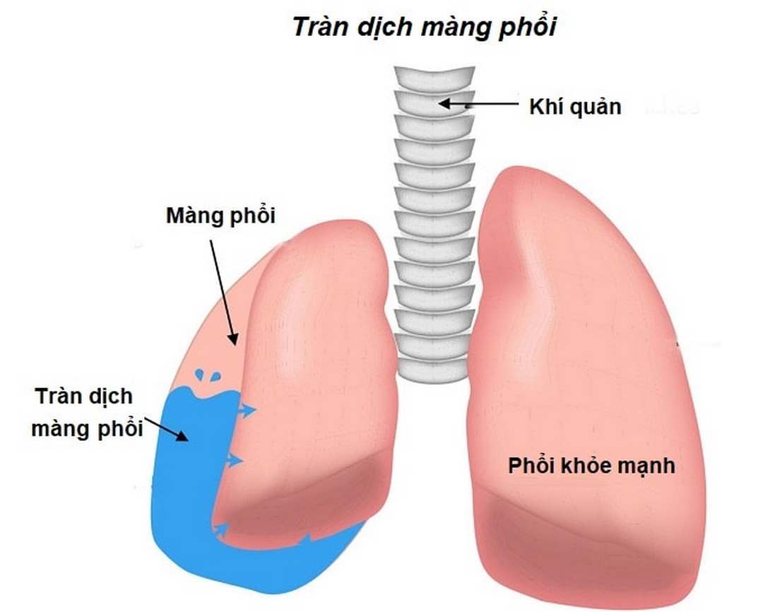 Cách chuẩn đoán bệnh tràn dịch ở màng phổi hiệu quả