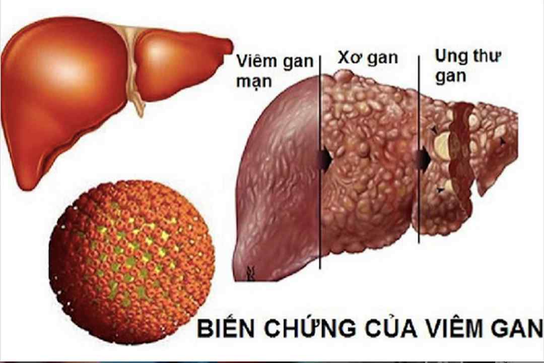 Các triệu chứng của bệnh 