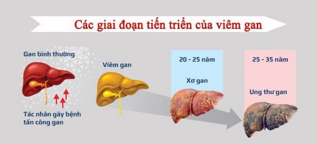 Đối với bệnh nhân mắc viêm gan mãn tính