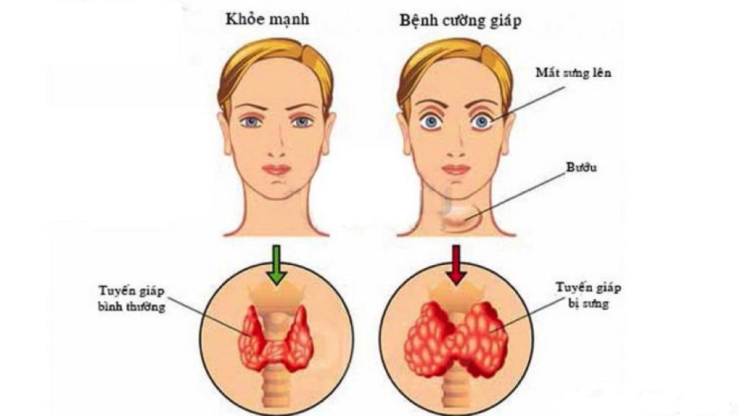 Bệnh cường giáp được hiểu như thế nào?