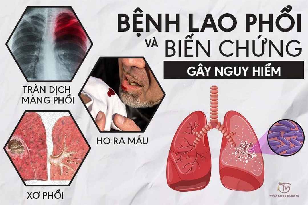 Hiện nay xuất hiện nhiều biến chủng của lao phổi trên thế giới 