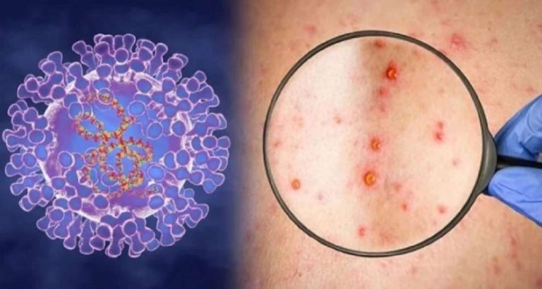 Vi khuẩn Mycobacterium leprae một trong những nguyên nhân gây ra bệnh 