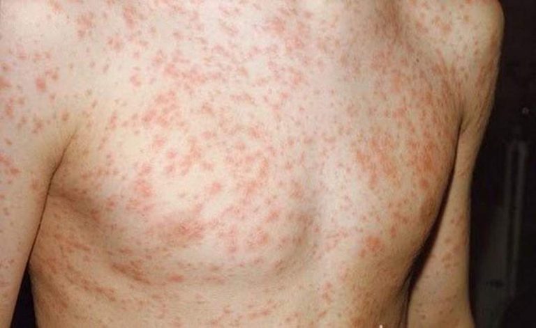 Tổng quát bệnh sởi (Morbilli) giúp nắm rõ kiến thức bệnh