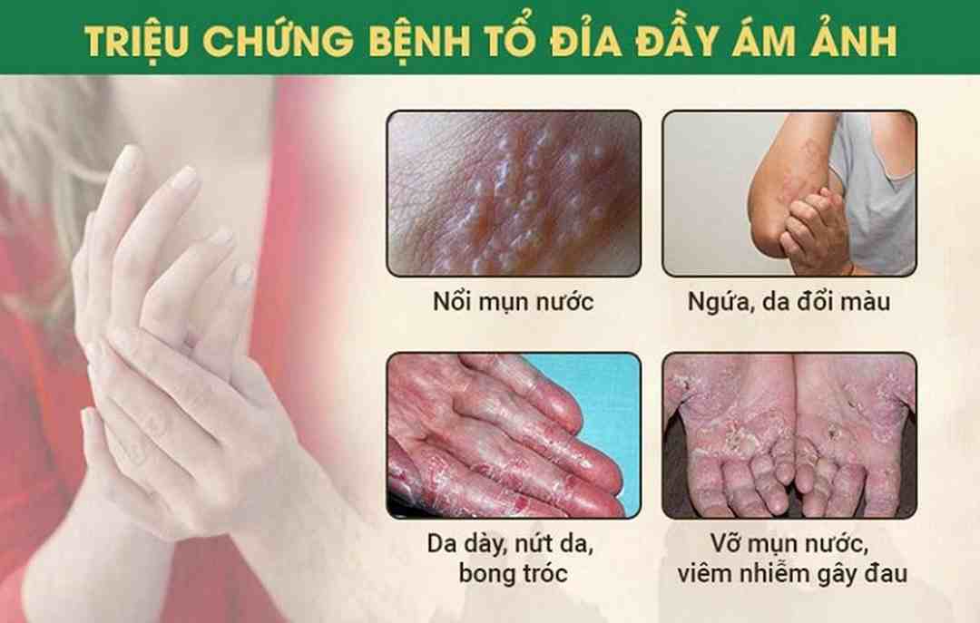 Triệu chứng ban đầu của bệnh tổ đỉa như thế nào?