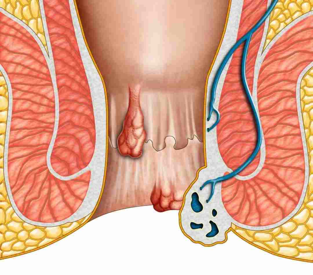 Bệnh trĩ là bệnh liên quan đến trực tràng và hậu môn