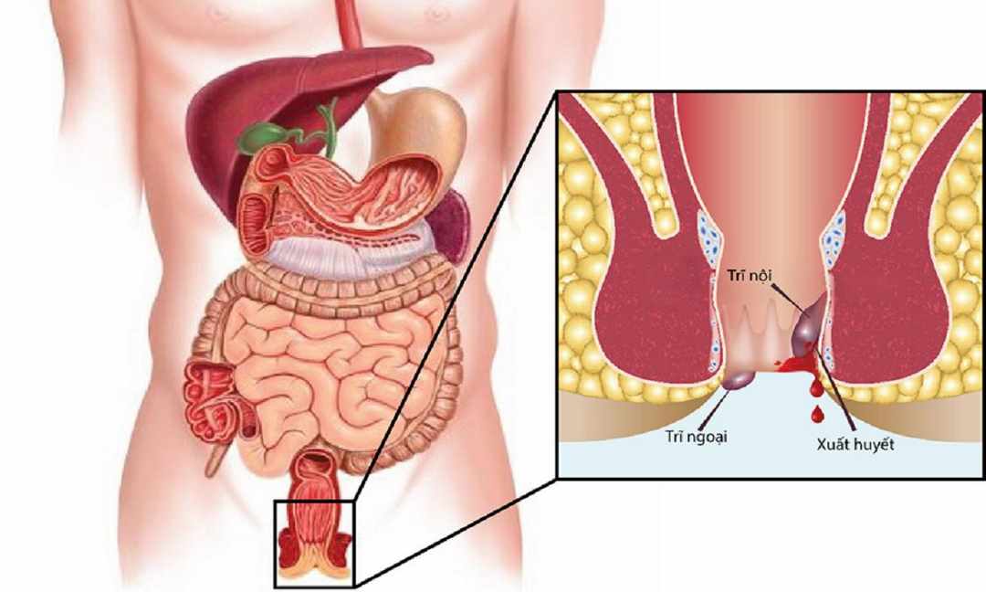 Biến chứng bệnh trĩ