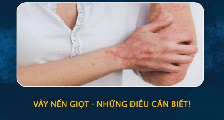 Vảy nến là căn bệnh về da phổ biến thường gặp 