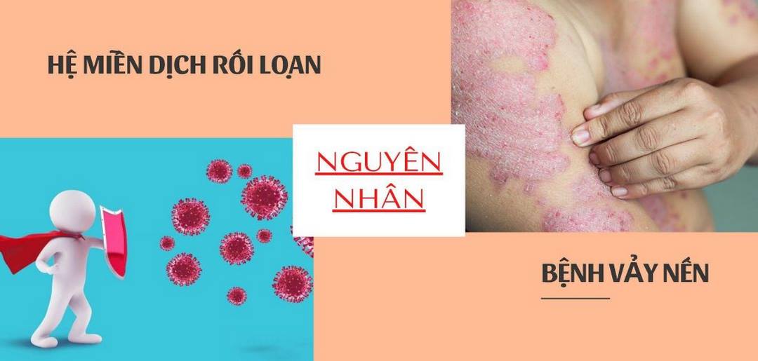 Bệnh vảy nến gây ra các biến chứng nguy hiểm liên quan