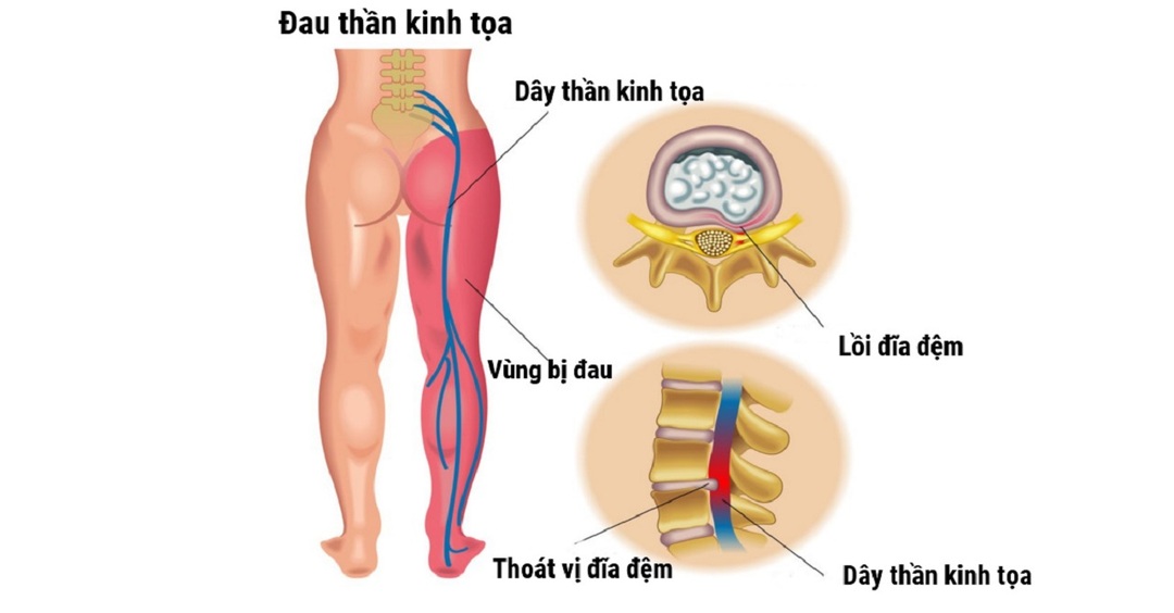 Đau thần kinh tọa là bệnh xương khớp phổ biến thứ 2