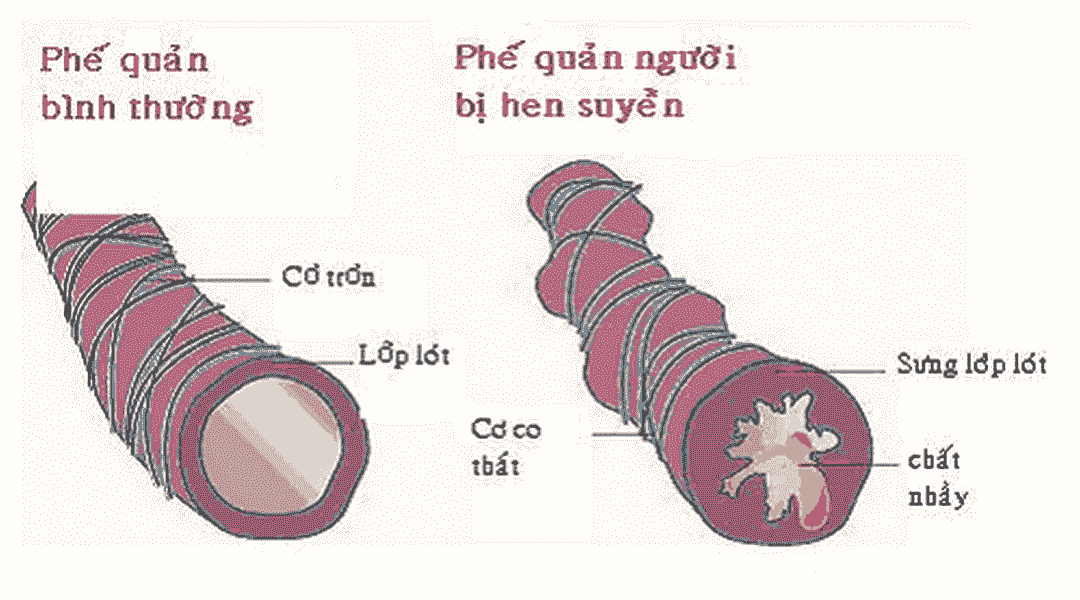 Phân biệt phế quản người bình thường và người bệnh