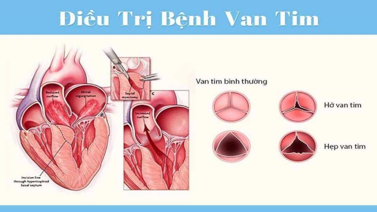 Hình ảnh van tim bình thường và van tim bị hở