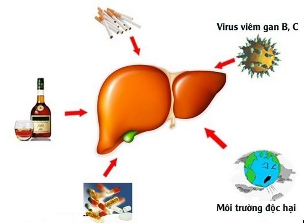 Các tác nhân ảnh hưởng đến men gan gây bệnh men gan cao 