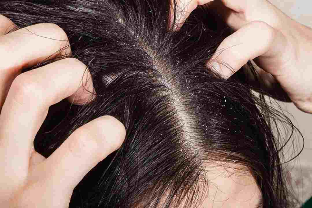 Nấm gây ra nhiều triệu chứng khó chịu cho vùng da đầu người bệnh