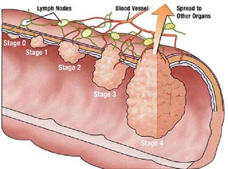 Polyp đại tràng có xu hướng gia tăng ngày càng nhiều