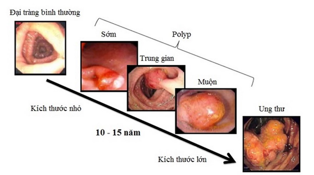 Đến ngay bệnh viện để chữa trị đại tràng kịp thời