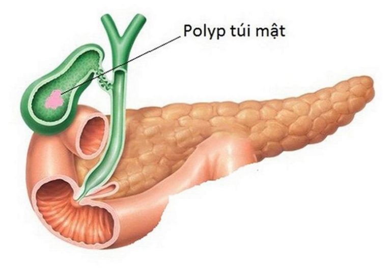 Polyp túi mật xuất hiện với các triệu chứng nhẹ