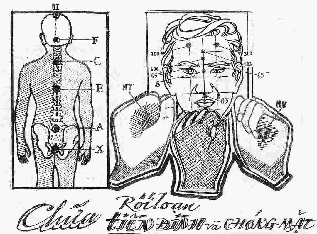 Cách để điều trị Rối loạn chức năng tiền đình