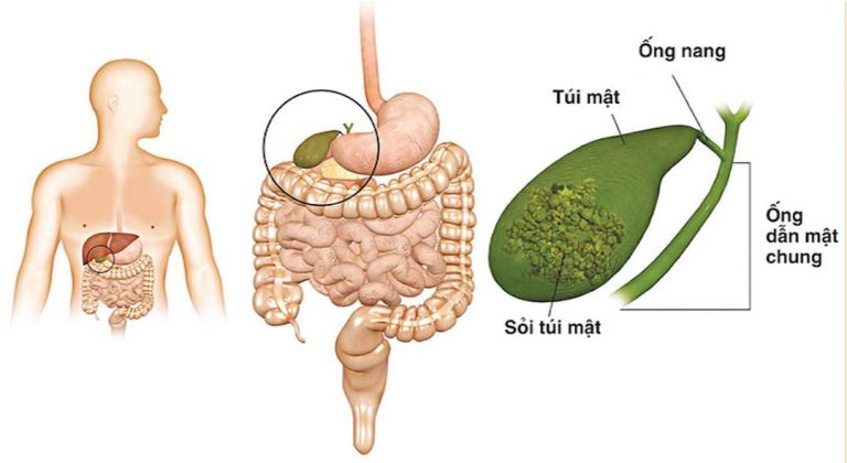 Sỏi mật là bệnh lành tính của đường tiêu hoá