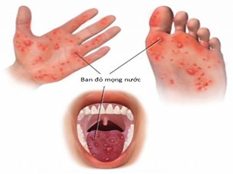 Từ 3 đến 6 ngày sau khi nhiễm virus sẽ có triệu chứng bệnh 