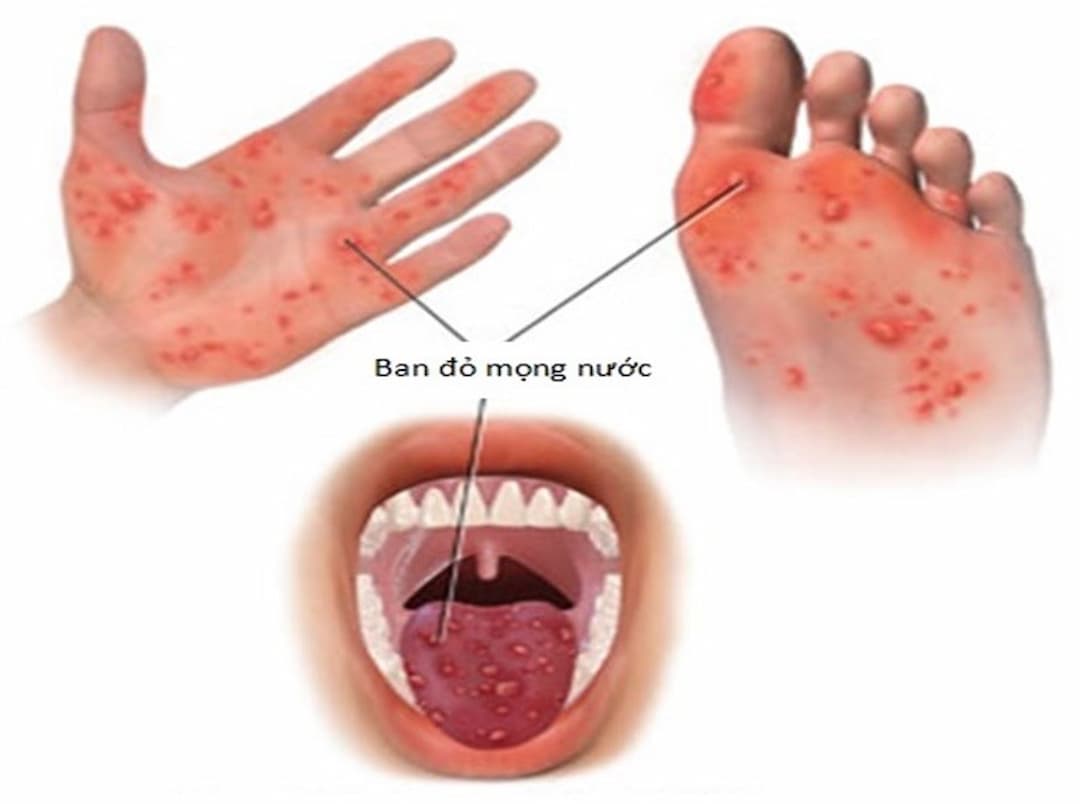 Từ 3 đến 6 ngày sau khi nhiễm virus sẽ có triệu chứng bệnh 