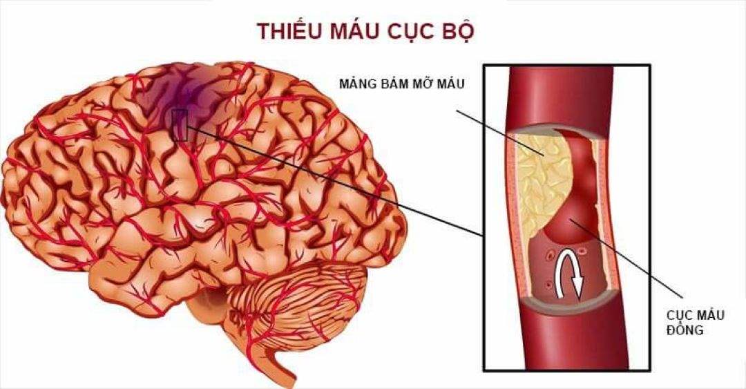 Các triệu chứng thường gặp