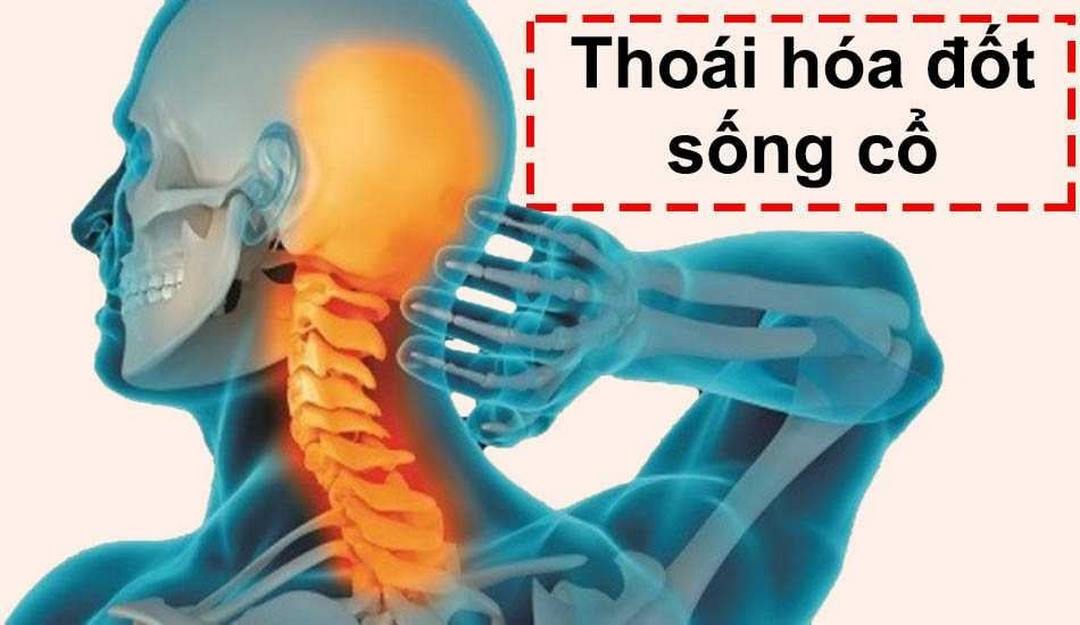 Bạn có biết thoái hóa đốt sống cổ là gì?