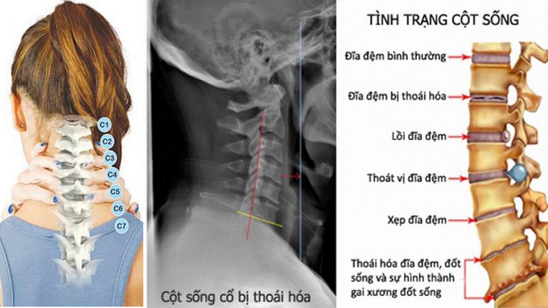 Chi tiết từng đốt xương cột sống cổ