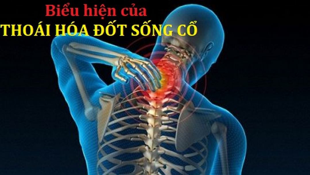 Những triệu chứng khi mắc phải bệnh thoái hóa đốt sống cổ