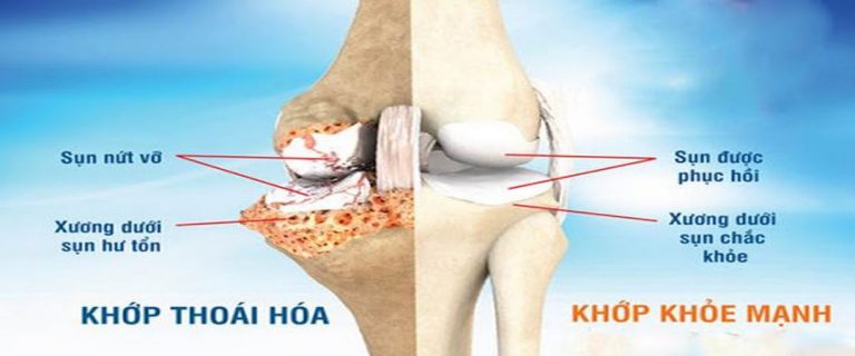 Thoái hóa khớp gối – Những vấn đề cần được quan tâm