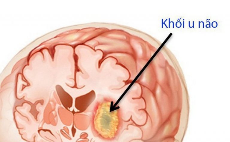 U não căn bệnh quái ác xảy ra nhiều hơn hết