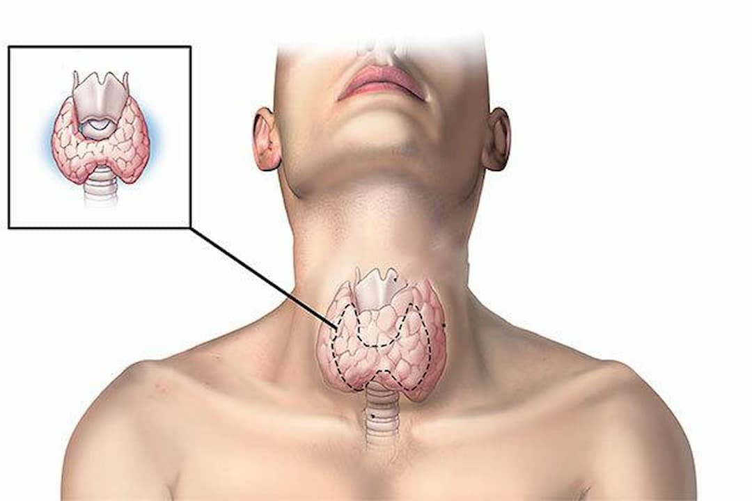 Xạ trị là một cách điều trị cho các khối u ở tuyến giáp 