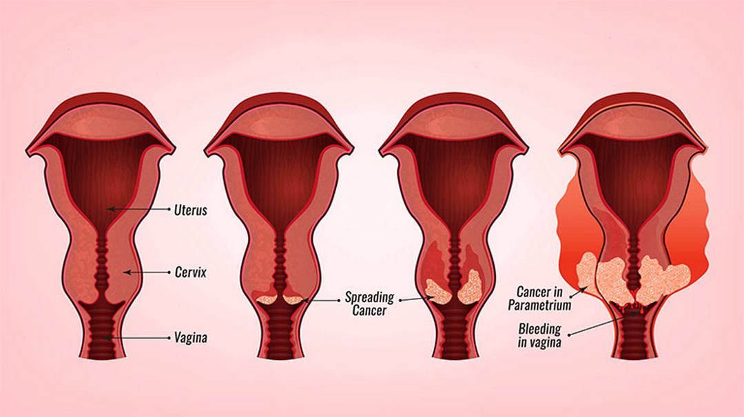 Việc quan hệ tình dục quá sớm sẽ gia tăng tỷ lệ mắc bệnh 