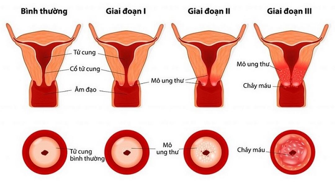 Các giai đoạn phát triển của “khối u ung thư cổ tử cung” 