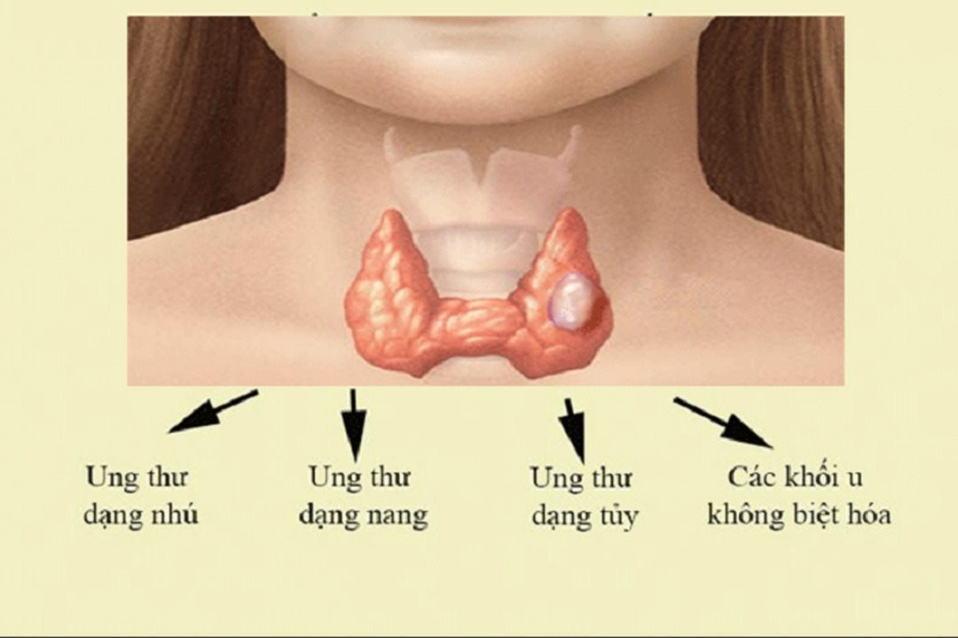 Các loại ung thư tuyến giáp thường gặp ở người bệnh 