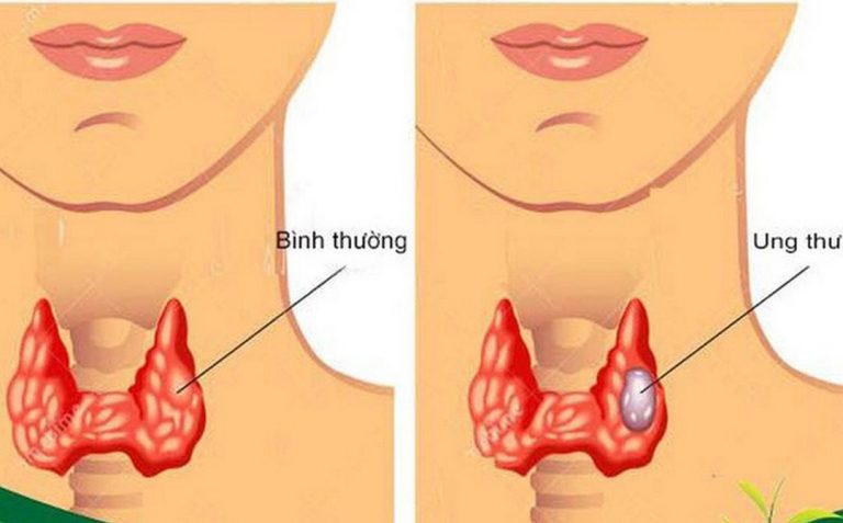 Tuyến giáp của người bình thường và bị bệnh khác nhau như thế nào? 