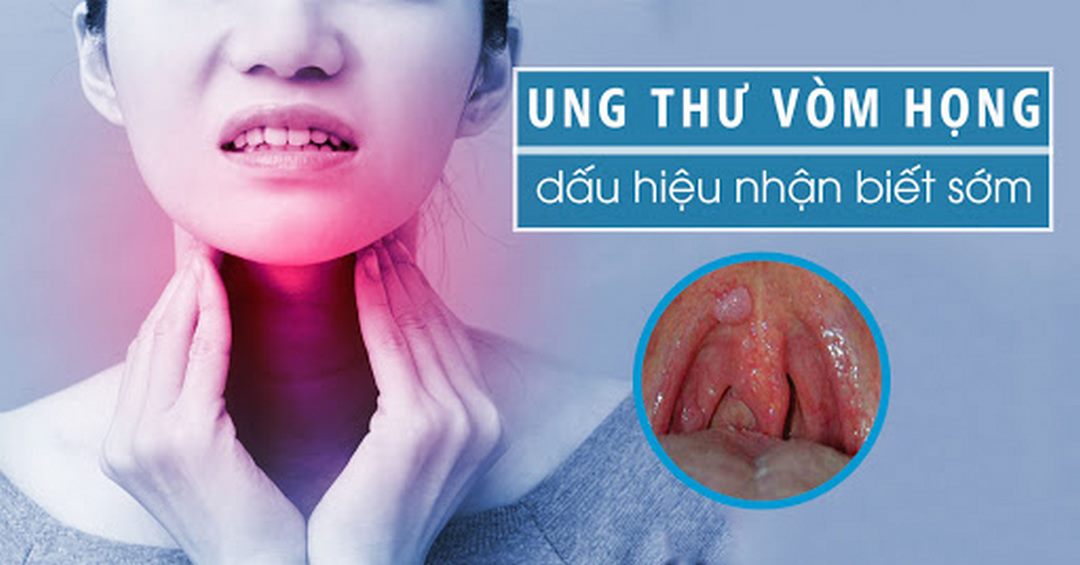 Tìm hiểu về ung thư vòm họng với những dấu hiệu nhận biết sớm