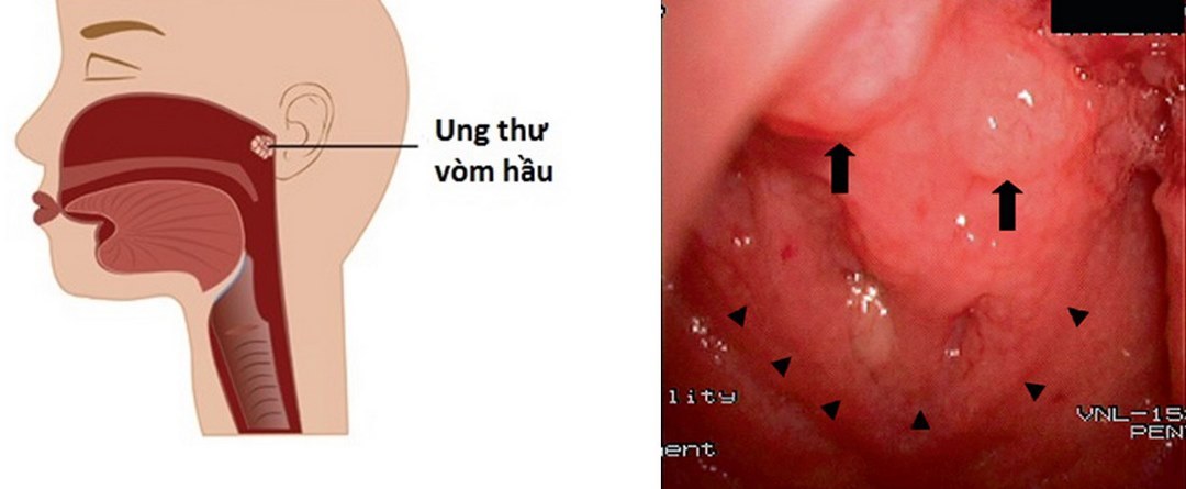 Ở giai đoạn sau ung thư sẽ có những biểu hiện rõ ràng hơn