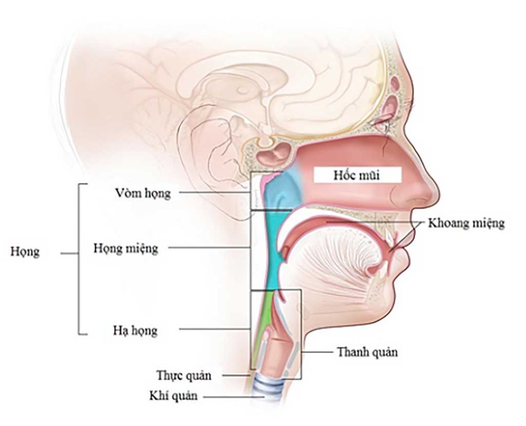 Sưng hạch cổ ở bệnh nhân bị ung thư vòm họng