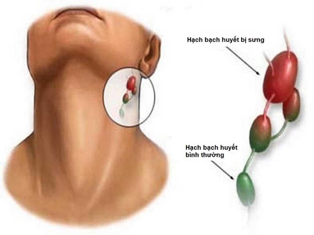 Để ý nguyên nhân gây bệnh để thực hiện phòng, chống