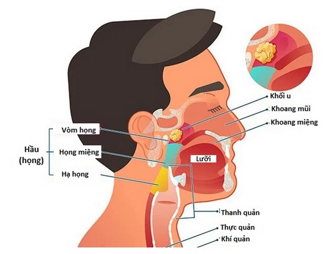 Người bệnh có thể chẩn đoán ung thư vòm họng bằng hình ảnh 