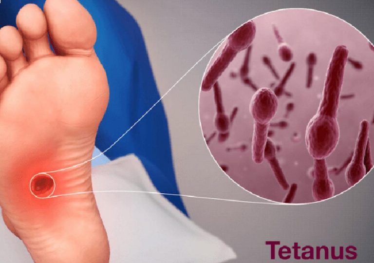 Trực khuẩn Clostridium tetanus gây nên bệnh uốn ván vô cùng nguy hiểm