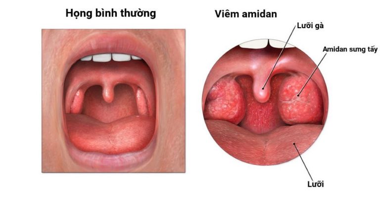 Khái quát vài nét về bệnh viêm amidan