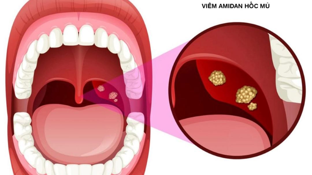 Các trường hợp nên thực hiện tiểu phẫu cắt viêm amidan 