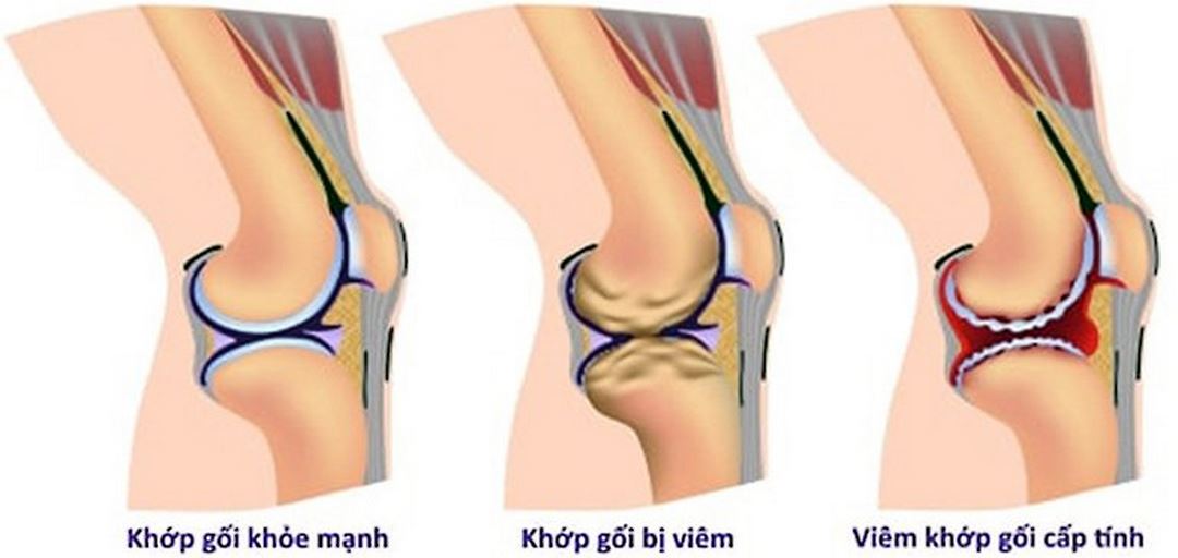 Viêm khớp dạng thấp giai đoạn 3 đã thể hiện dấu hiệu rõ ràng