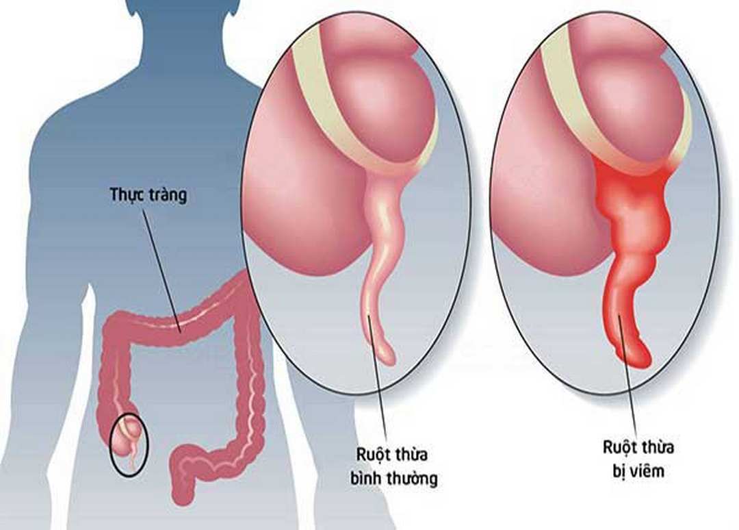 Ruột thừa bị viêm ở trẻ em