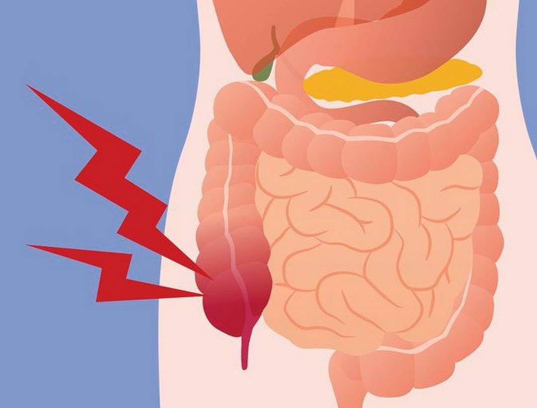 Cách chẩn đoán viêm ruột thừa chính xác