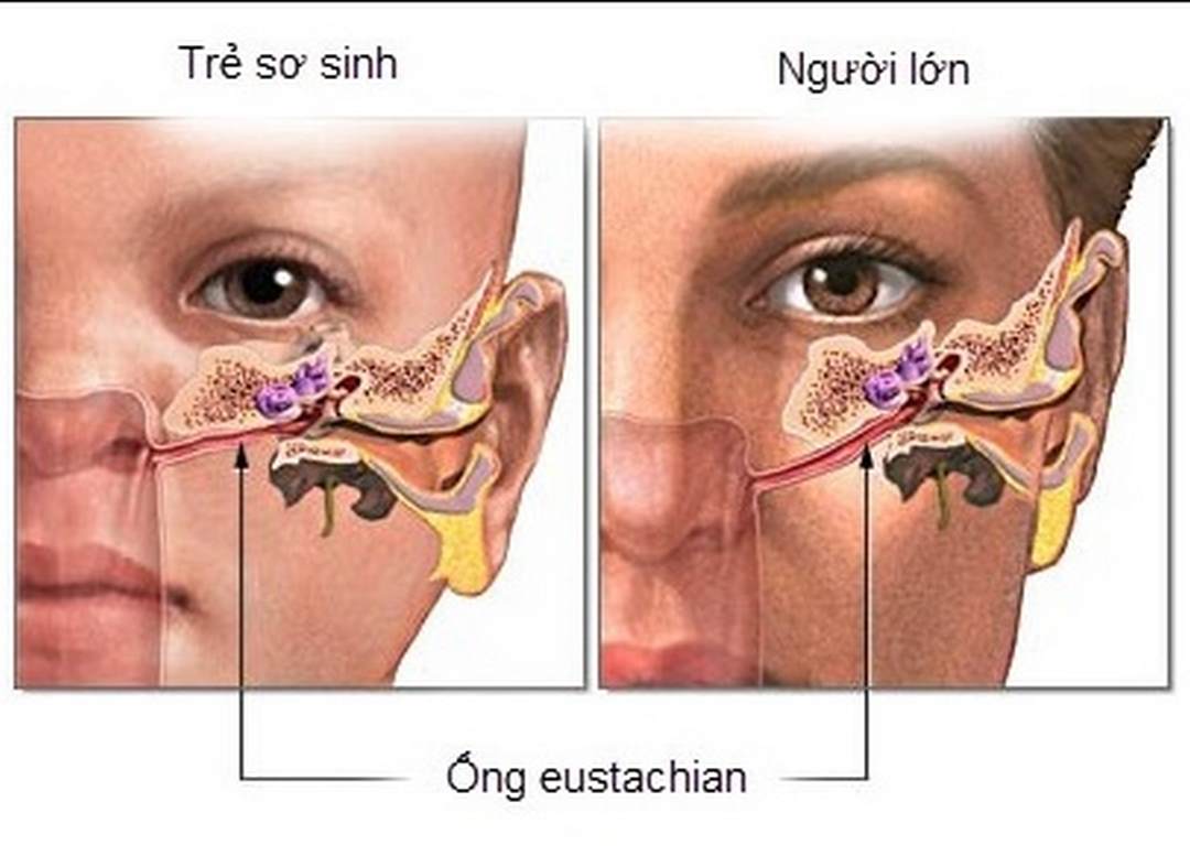 Trẻ em dễ bị viêm tai giữa hơn so với người lớn